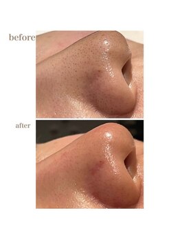 ユジュ(yju)/毛穴の開き　黒ずみ　角栓