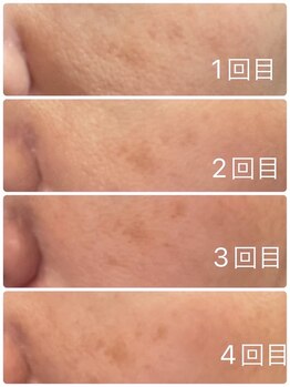 長寿鍼灸院 長寿整骨院/ハリネズミ女優美容鍼効果★