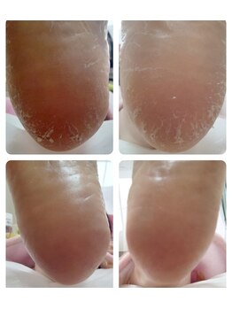 リゼランアンドコー 福島鎌田店(LIZERA&Co)/ツルスベかかと♪