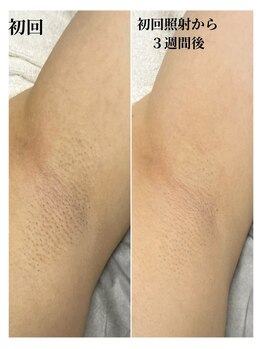 ルシャトン(Le Chaton)/ワキ脱毛