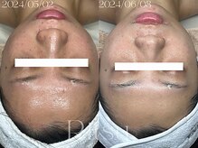 リツ(Ritsu)/美白