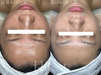 リツ(Ritsu)/美白