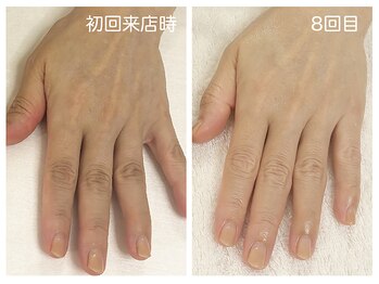 キレイテ 福岡天神店/関節の黒ずみにお悩み