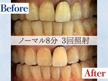 LBSホワイトニング 吉祥寺店/ホワイトニングビフォーアフター