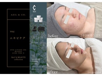 オーヴォ リビングスパ アネックス マノン(OVO LIVING SPA annex MANON)/【施術事例】ニキビケア