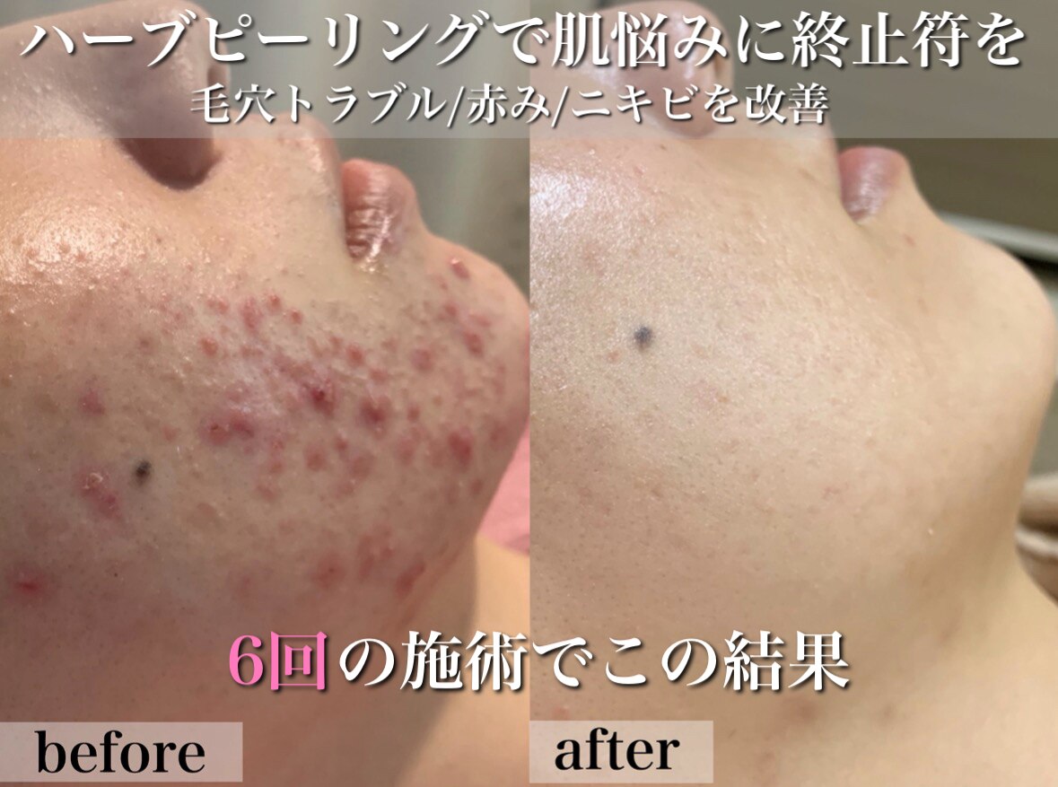 大阪市でピーリングが人気のエステサロン｜ホットペッパービューティー