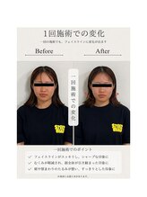 ハリスタ(HARISTA) 1回施術 この変化★