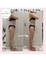 シーディーエム(cdm)/イヤーセラミック3ヶ月後