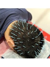 よつば鍼灸整骨院 春日院/頭皮鍼