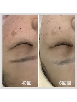 じゅえる/→続き シミケア10分6回の効果