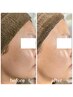 【毛穴ケア/艶肌/美白】DTなし無農薬ハーブピーリング(毛穴洗浄付)