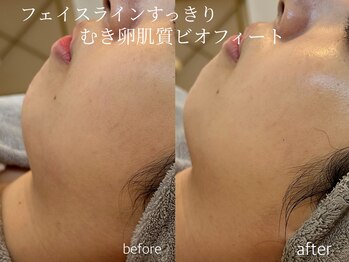 シェア(share.)/剥離なしハーブピーリング