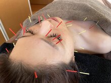 結果にこだわった美容鍼灸や美容エステメニュー施術