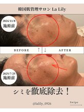 ラリリー(La Lily)/ミコステラでシミ改善