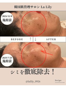 ラリリー(La Lily)/ミコステラでシミ改善