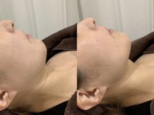 ピュアリー(purly)/【レモンボトル】Before After