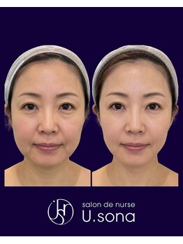 小顔・脂肪コントロール専門 salon de nurse U.sona～松本店～/【顔造形】40代脂肪分解症例