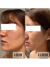 セイリキ(SEIRIKI)/光フェイシャル