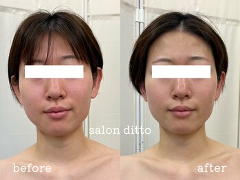 サロンディト(ditto)/施術1回/クイックコルギ+顔脱毛
