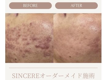 シンシア(SINCERE)/オーダーメイド肌改善プログラム