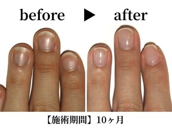 深爪スタンダードコース¥11,000