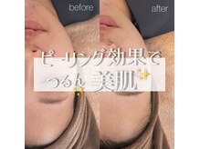 メルシートータルビューティー(MERCI)の雰囲気（プラズマ光フェイシャルの効果がすごい！ツルピカ初回6600円）