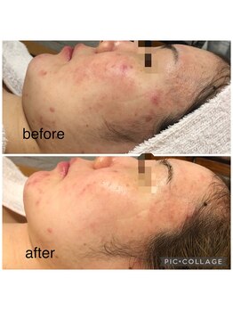 エスカル ボーテ(escale beaute)/ニキビケア・乾燥肌