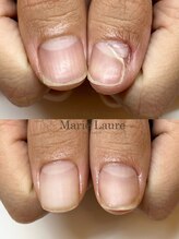 マリーロール 淀屋橋本店(Marie Laure)/自爪育成/深爪矯正/ネイルケア