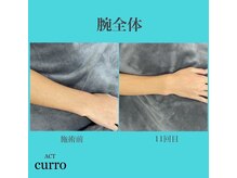 アクト クロ(ACT curro)/【腕全体】脱毛施術例