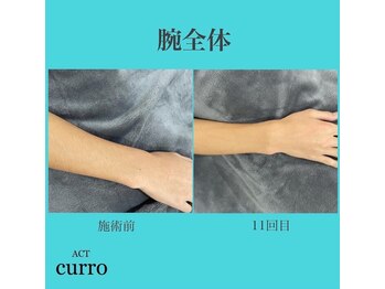 アクト クロ(ACT curro)/【腕全体】脱毛施術例