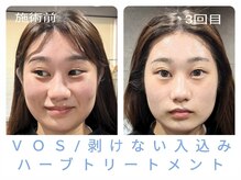 エクラ(Eclat)/ブライダル/小顔/毛穴/美白肌