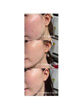 アルティ 福岡大名店(ARTI,)/プラズマニキビケア