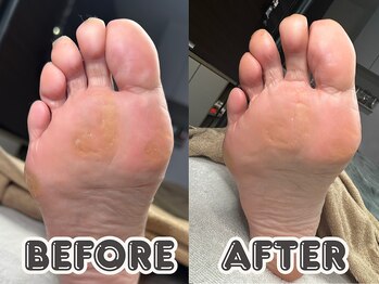 ポドロ ウィズ ニコルル 大阪天満店(PoDoLo with Nicolulu)/【タコ】フットケア大阪・梅田