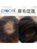 【0円】育毛促進無料カウンセリング