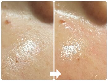 サロン ド ジョワ(salon de joie)/50代毛穴ない！よみがえった艶肌