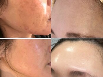 カノネ(Cannone')/ハーブピーリング / シミ