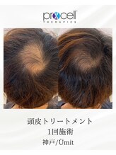 ユミト(Umit)/プロセルスカルプ