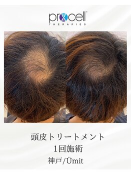 ユミト(Umit)/プロセルスカルプ