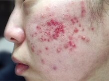 ハーバリー ハーブピーリング 名古屋店(HERBERRYハーブピーリング)