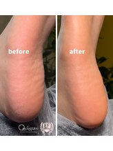 オンシジューム(Oncidium)/足裏角質ケア♪