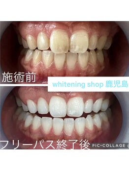 ホワイトニングショップ 鹿児島店/#鹿児島ホワイトニング