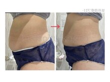 メディカルエステ 大宮店/＊日本初-12℃脂肪冷却症例＊