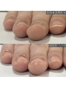 ギフト(GIFT)/自爪育成ネイルケア