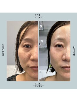 サロン ド ラヴィエール(salon de Laviere)/エクソリフト