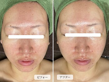 スローガーデン(Slow Garden)/ハーブピーリング