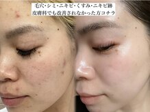 リベルキョウト 京都駅前店(Liber Kyoto)の雰囲気(ニキビ・シミ改善に特化した【国内最高濃度】肌質改善ピーリング)