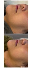 アロラヴィ(AroRavi)/レモンボトル[顔のお肉撃退]