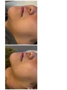 アロラヴィ(AroRavi)/レモンボトル[顔のお肉撃退]