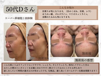 リボーン 柏(REBORN)/砂漠肌に土台からアプローチ