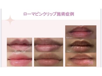 アンジェロ(Angelo)/ローマピンク施術【唇】